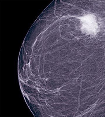 Breast Mammogram